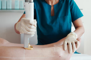 laser épilatoire - femme