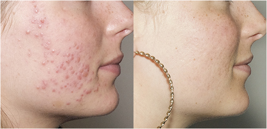 acne_avant-apres