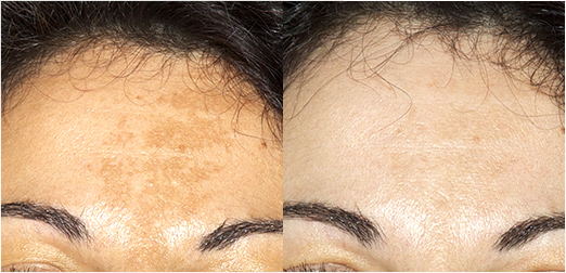 chloasma_front_avant-apres