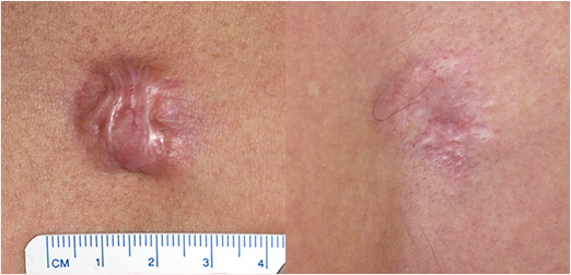 cicatrices_avant-apres