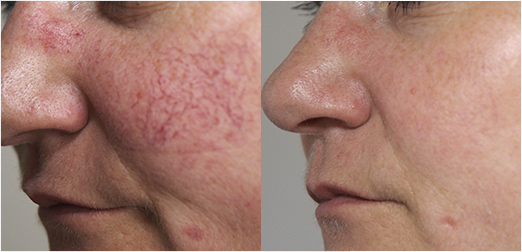 couperose_avant-apres