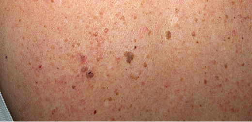 keratoses_seborrheiques_du_dos