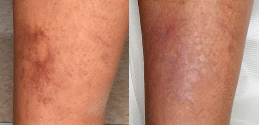 telangiectasies_avant-apres