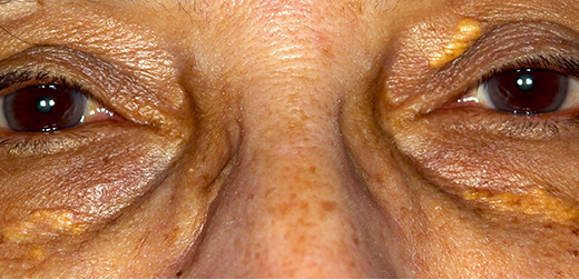 xanthelasma_des_paupieres